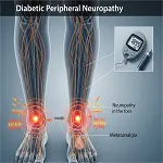 Neuropathy