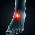 Diabetic foot ulcer