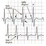 Fibrillation
