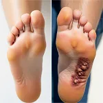 Peripheral Neuropathy