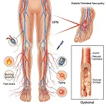 Peripheral Neuropathy