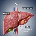Liver Disease