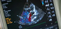 Do Simple Hemodynamic Measures Predict Outcomes in HFrEF?