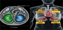 MRI and Pulmonary Hypertension