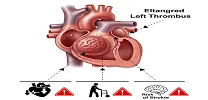 Stroke and Embolism Risk