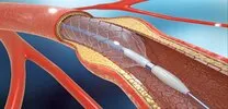 Greater Absolute Benefit With Paclitaxel Balloon in Multilayer ISR