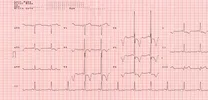 Can Conduction System Pacing Prevent Pacing-Induced Cardiomyopathy?