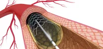 Abbreviated DAPT Regimen After PCI: Does Less Mean More for Safety?