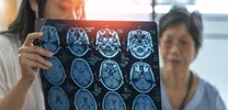 MRI shows high accuracy in detecting myocardial hemorrhage post-AMI