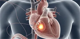 Catheter Ablation
