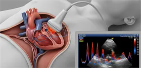 Echo in Heart Failure