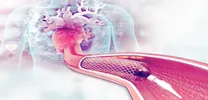 Balloon or Self-Expandable? Bicuspid Valve TAVR Shows Diverging Risks