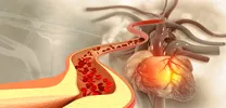 Invasive Therapy Drives Faster Angina Resolution in ISCHEMIA Analysis