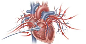 Flow Pump for STEMI