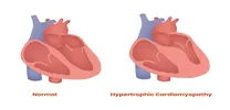 Aficamten Shows Superior Structural and Functional Benefits Over Metoprolol in Obstructive HCM