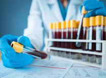Early Dual Antiplatelet Therapy Lowers Stent Thrombosis and Improves Outcomes in PCI