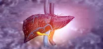 Liver cirrhosis