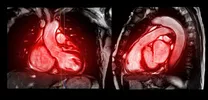 Heart imaging