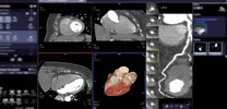 hsTnT Threshold May Safely Rule Out Acute Myocarditis