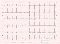 Deep Learning Model Predicts Short-Term Mortality in ICU Patients With Prolonged QT Intervals