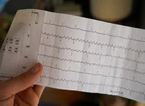 Local Conduction Velocities Predict Atrial Fibrillation Drivers and Recurrence