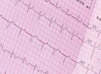 Atrial Fibrosis Predicts Mortality in Cardiac Amyloidosis Patients