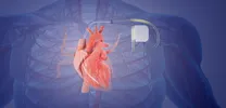 Pacemaker