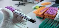 Variable HbA1c Patterns Signal Higher Complication Risk in Type 2 Diabetes