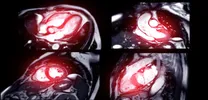 Apical Sparing Linked to Advanced Cardiac Amyloidosis in wtATTR