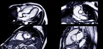 IGF-I, Not Glycemic Control or MG-HI, Linked to Bone Health in Adolescents With T1D