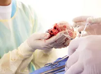 Abandoned Leads Raise Risks in Transvenous Lead Extraction