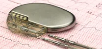 CSP Demonstrates Comparable One-Year Outcomes to BiVP in CRT Patients