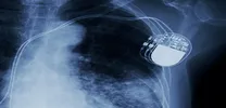 Septal Purkinje Capture Explains Narrow QRS in Left Bundle Branch Area Pacing