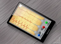 ECG-Based AI Model Detects Aortic Stenosis Years Before Valve Replacement