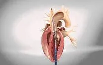 Excessive Valve Canting Linked to HALT After Aortic Valve Replacement