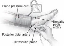 Arterial Stiffness Predicts Heart Failure Risk in High-Risk Patients