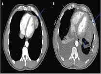 Left Atrial Strain Identifies Isolated Atrial Amyloidosis in Surgical Patients