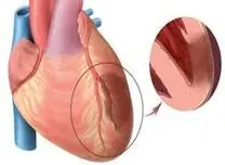Myocardial Damage Tied to Poor Exercise Capacity in NICM Patients