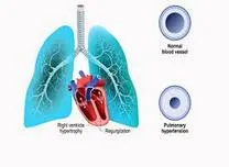 Triple Combination Therapy with Oral IP Receptor Agonist Shows Consistent Efficacy in PAH
