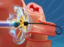 Pulsed-Field Ablation Catheter Sizes Show Comparable Outcomes in Atrial Fibrillation