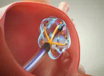 Hemolysis Biomarkers Vary Across Pulsed-Field Ablation Systems for AF