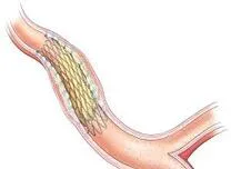 	Shorter Dual-Antiplatelet Therapy Reduces Bleeding After Coronary Intervention