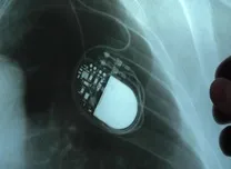 High-Voltage Pulsed Field Ablation Effectively Treats Scar-Related VT