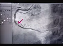 High-Risk Plaques Defy Risk Scores, Predict Events Even in ‘Low-Risk’ Patients