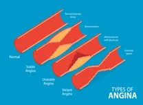 Stratified Treatment Improves Angina Outcomes in MINOCA Patients
