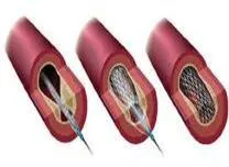Diabetes Elevates Long-Term Risk After Coronary Stenting Regardless of Peripheral Arterial Disease