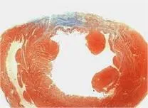 Individualized Maximal Wall Thickness Does Not Improve Sudden Cardiac Death Prediction in Hypertrophic Cardiomyopathy