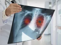 Imaging and FFR guidance linked to superior better PCI outcomes than angiography