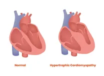 Cardiac MRI Epicardial Fat Metrics Enhance Accuracy of HCM Risk Stratification