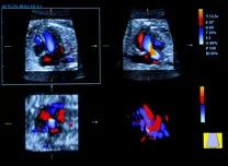 CMR-Derived PCWP Indicates Fibrosis and Cardiac Complications in β-Thalassemia Major